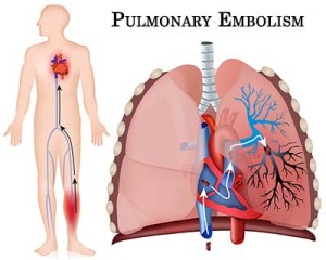 pulmonary-embolism